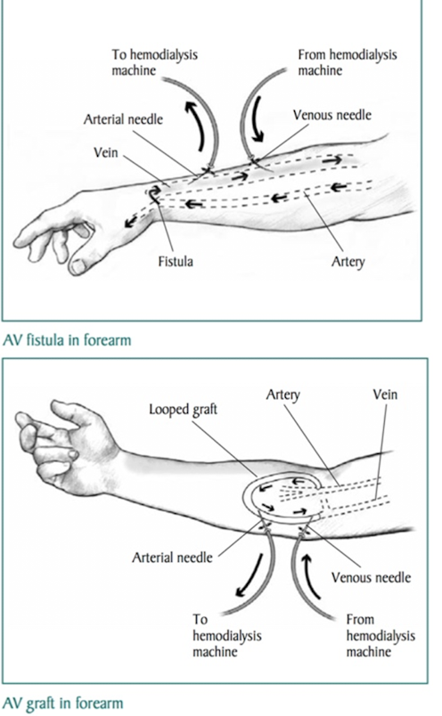 <p><strong>abnormal connection or passageway between artery and vein </strong><br>-may be congenital, surgically created for hemodialysis, acquired during trauma or erosion of arterial aneurysm </p>