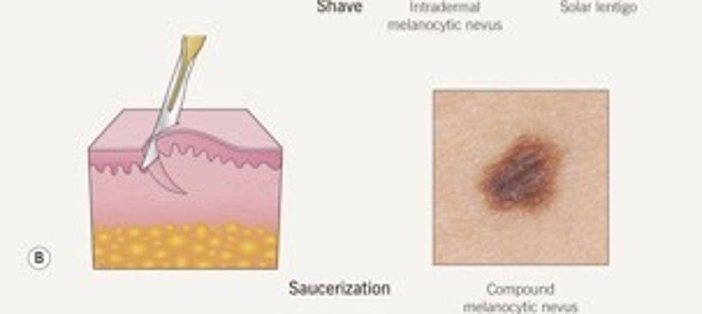 <p>Saucerization biopsy</p>