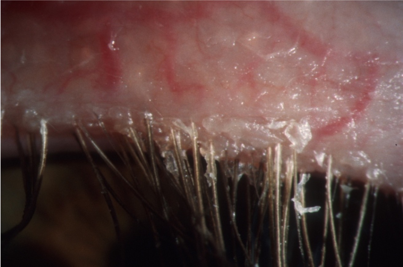 <p>What is the patient likely suffering from?</p><ul><li><p>The patient is experiencing sticky, crusty eyelids bilaterally</p></li><li><p>The patient has recurrent styes</p></li><li><p>The eyes are dry and sore</p></li><li><p>The patient is photophobic</p></li><li><p>They usually wear their contact lenses, but lately cannot tolerate them</p></li></ul><p></p>
