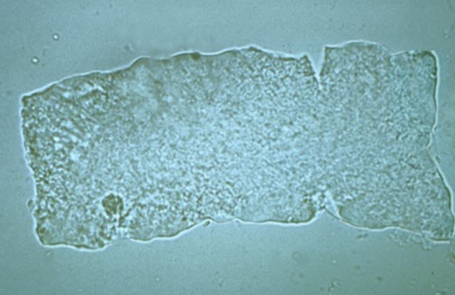 <ul><li><p>indicates renal failure</p></li></ul><p></p>