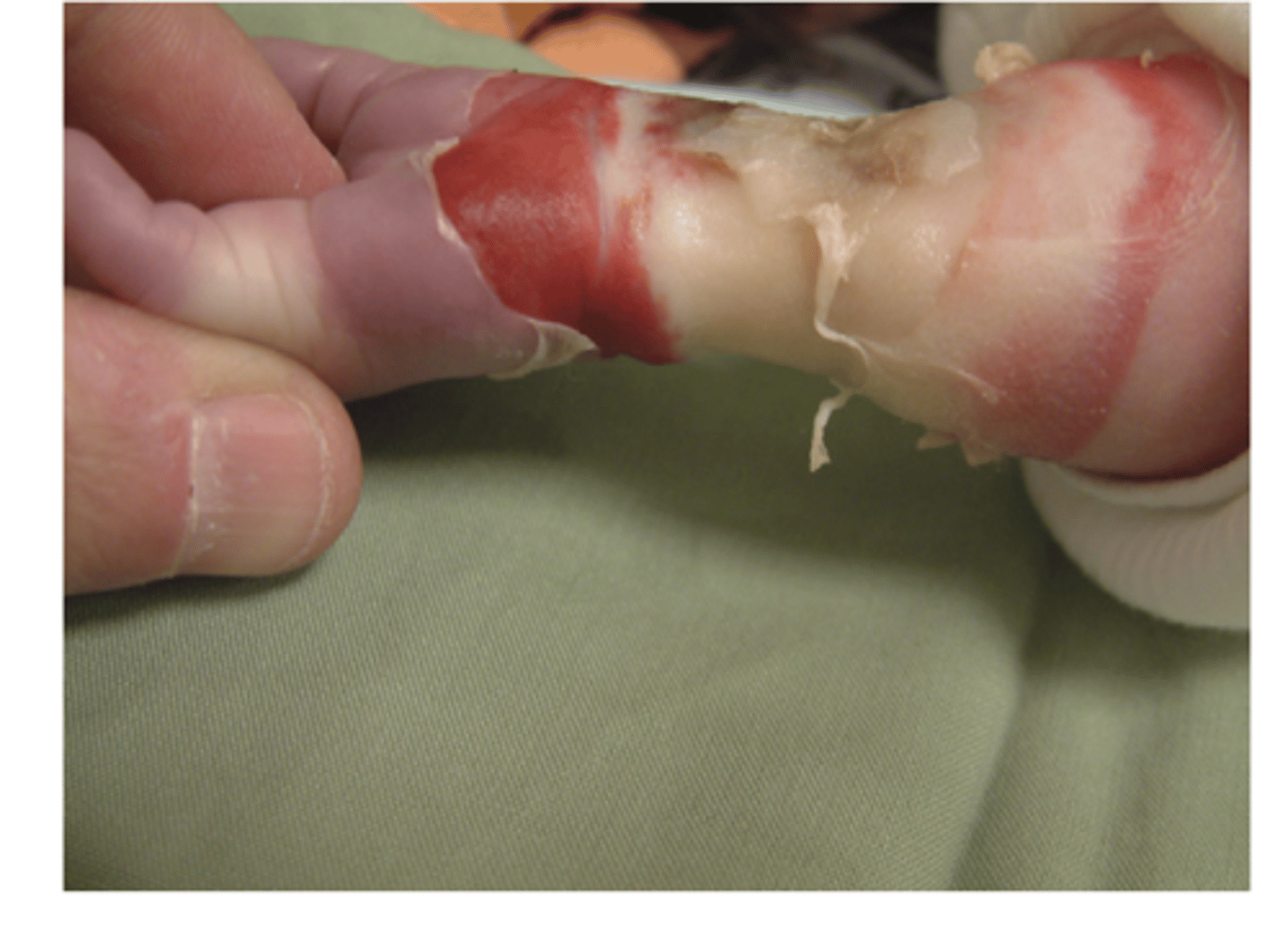 <p>Involve tissues down to the bone.</p>