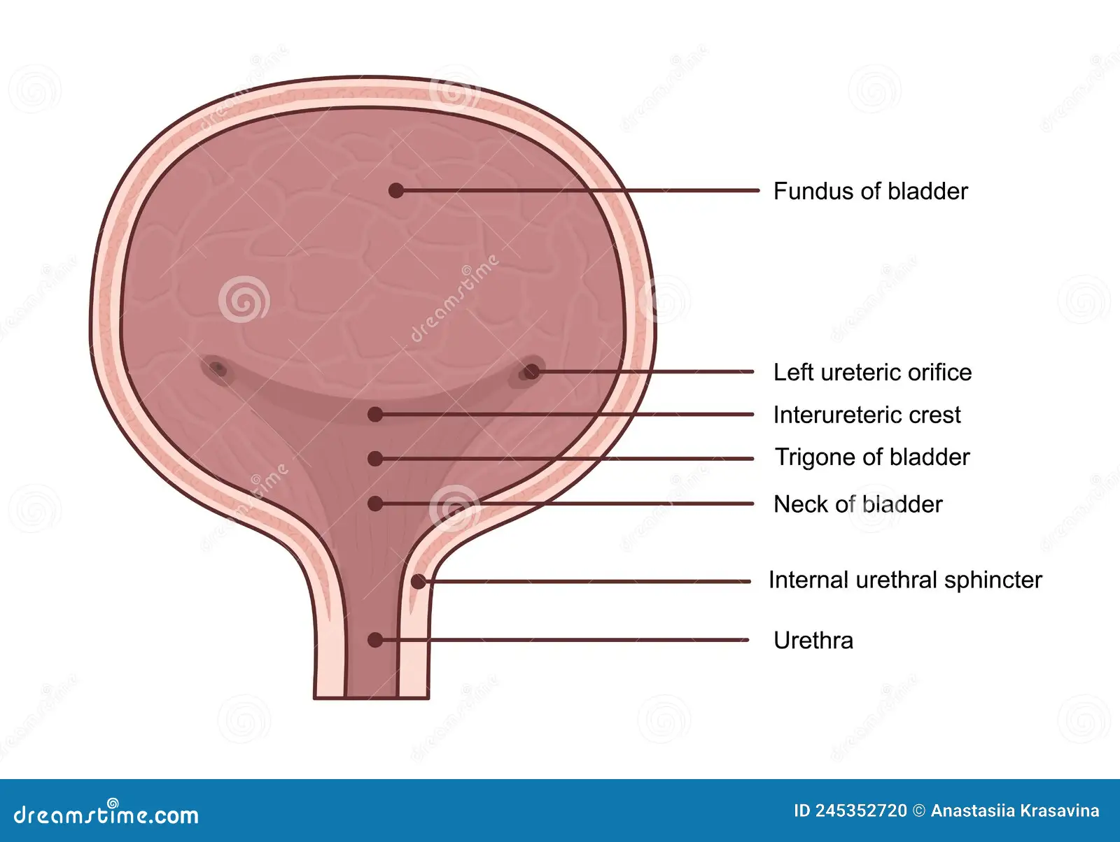 <p>The trigone of the bladder:</p><p>74. The trigone of the bladder</p><p>A. is paler than the rest of the lining of the bladder T</p><p>B. is developed from endoderm F</p><ul><li><p>trigone is actually derived from <strong>mesoderm</strong>, specifically from the incorporation of the mesonephric ducts into the bladder wall during development, unlike the rest of the bladder which develops from endoderm.</p></li></ul><p>C. is the least mobile part of the bladder T</p><p>D. is the least sensitive part of the bladder F</p><ul><li><p>trigone is actually <strong>more sensitive</strong> than other parts of the bladder because it contains many sensory nerve endings, which is why irritation there causes a strong urge to urinate</p></li></ul><p>E lies between the urachus and the openings of the ureters F</p><ul><li><p>trigone lies <strong>between the two ureteric orifices and the internal urethral orifice</strong>, not between the urachus and the ureteric openings. The urachus is a fibrous remnant of the allantois located superiorly on the bladder dome, away from the trigone</p></li></ul><p></p>