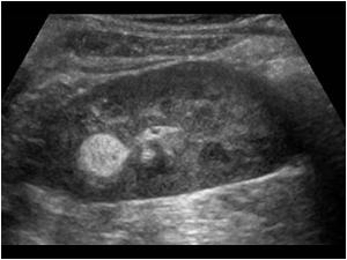<p>Angiomyolipoma</p>