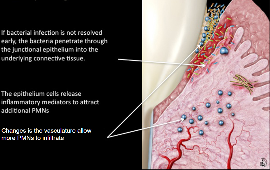 <ul><li><p>If bacterial infection is not revolved early, the bacteria penetrate through the junctional epithelium into the underlying connective tissue</p></li><li><p>the epithelium cells release inflammatory mediators to attract additional PMNs</p></li><li><p>changes in the vasculature allow more PMNs to infiltrate <u>and the loosening of the tissues allows more bacteria to come in</u></p></li></ul><p>still reversable</p>
