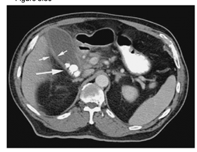 <p>What is occurring in the CT scan?</p>