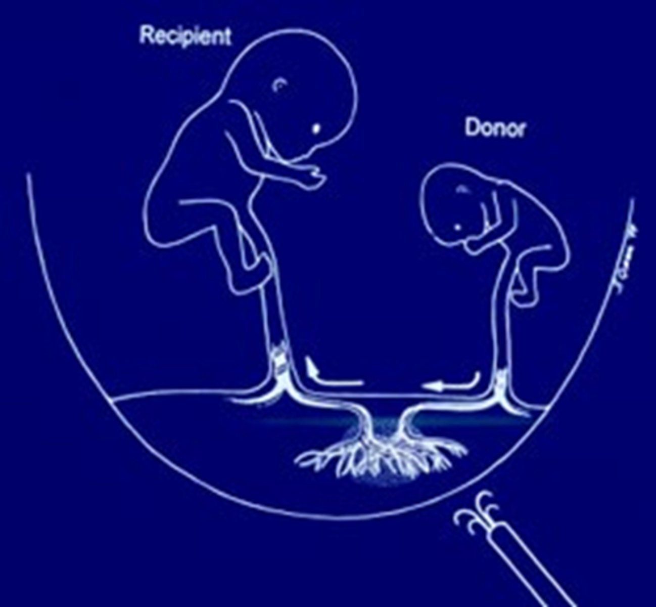 <p>Twin-twin transfusion syndrome (TTTS)</p>