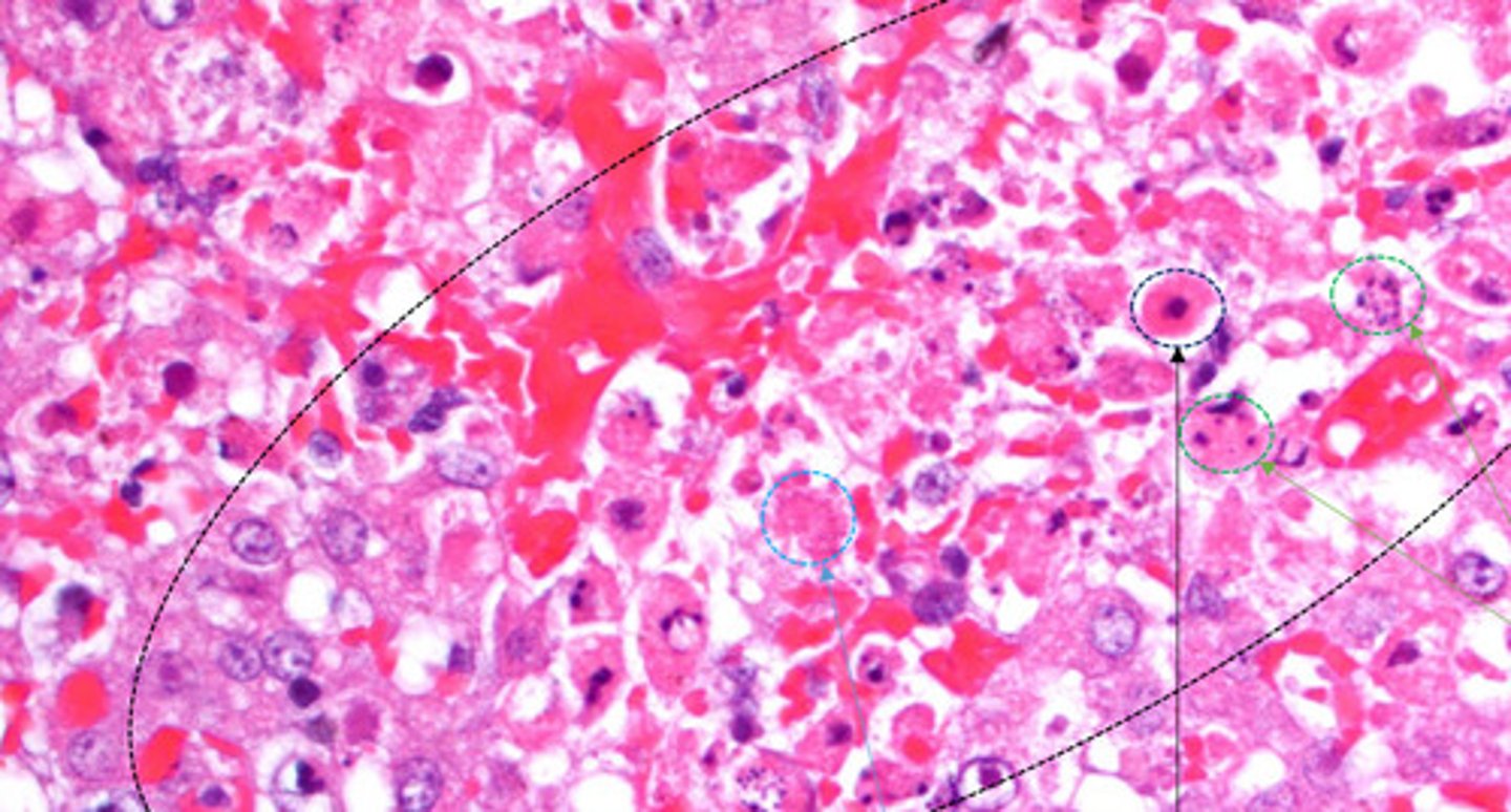 <p>Identify the microscopic pathology of the liver?</p>