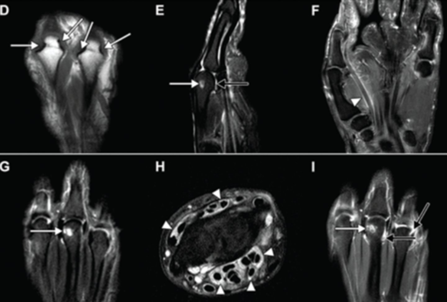 <p>MRI or US with synovial proliferation or bony erosions in both MRI and US</p>