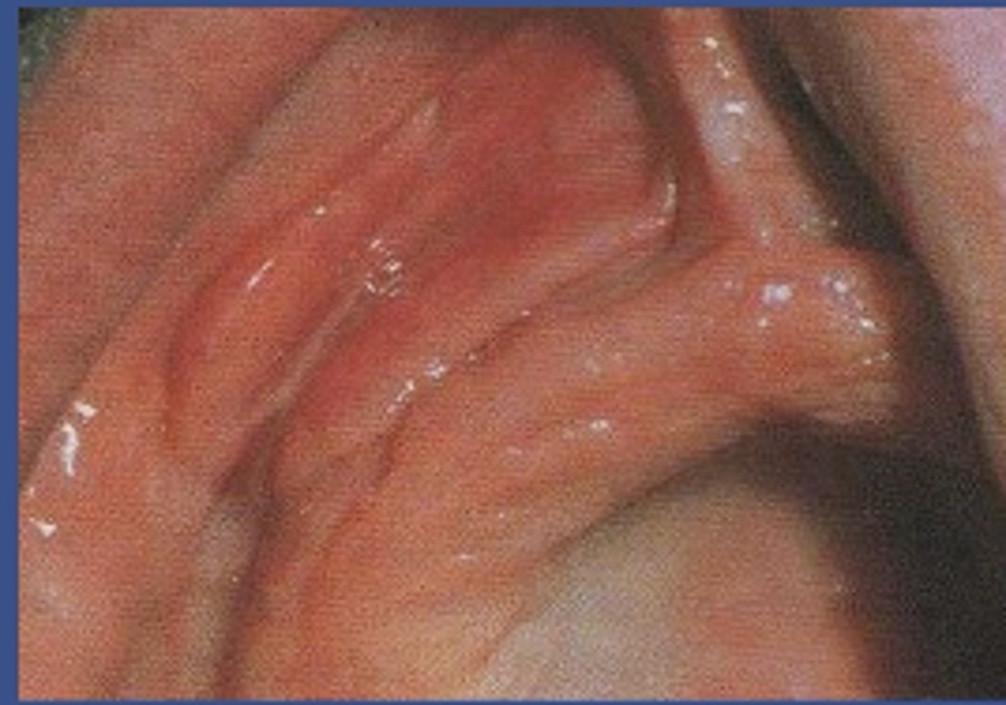 <p>When in correspondence to surgical removal do you reline/rebase?</p>