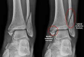 <p>Fracture of both malleoli and the posterior lip of the tibia ; usually represent fracture-dislocations</p>