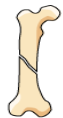 <p>Type of fracture? </p>