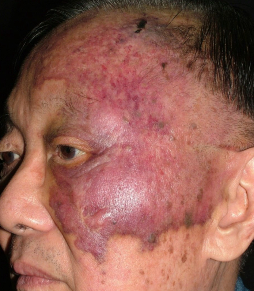 <p>what type of color change and condition is depicted</p>