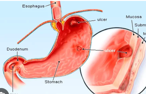 <p><span style="font-family: Droid Sans Mono, monospace">PEPTIC ULCER</span></p>