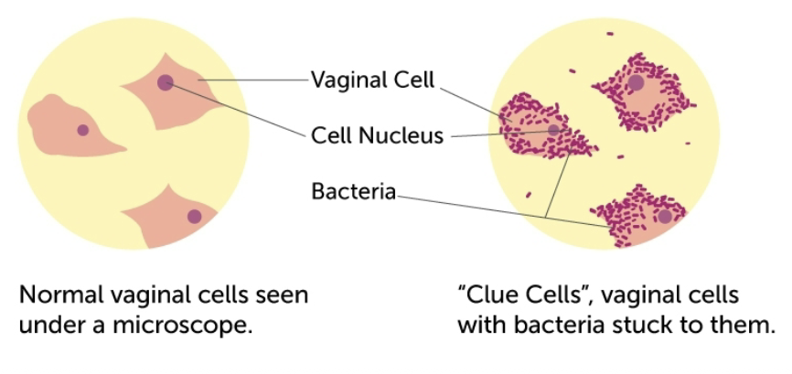 <p>venereal transmission that is associated with vaginitis. does not invade tissue, but grows in vaginal secretions. ID by clue cells, which are squamous epithelial cells with adhered masses of gram negative pleomorphic rods</p>