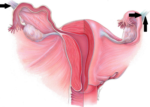 anchors ovary laterally to pelvic wall