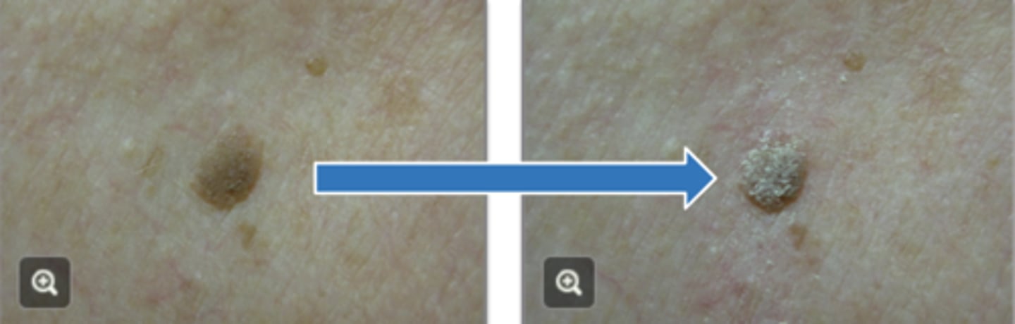 <p>What is a trick to tell if a lesion is a seborrheic keratosis if there is doubt?</p>