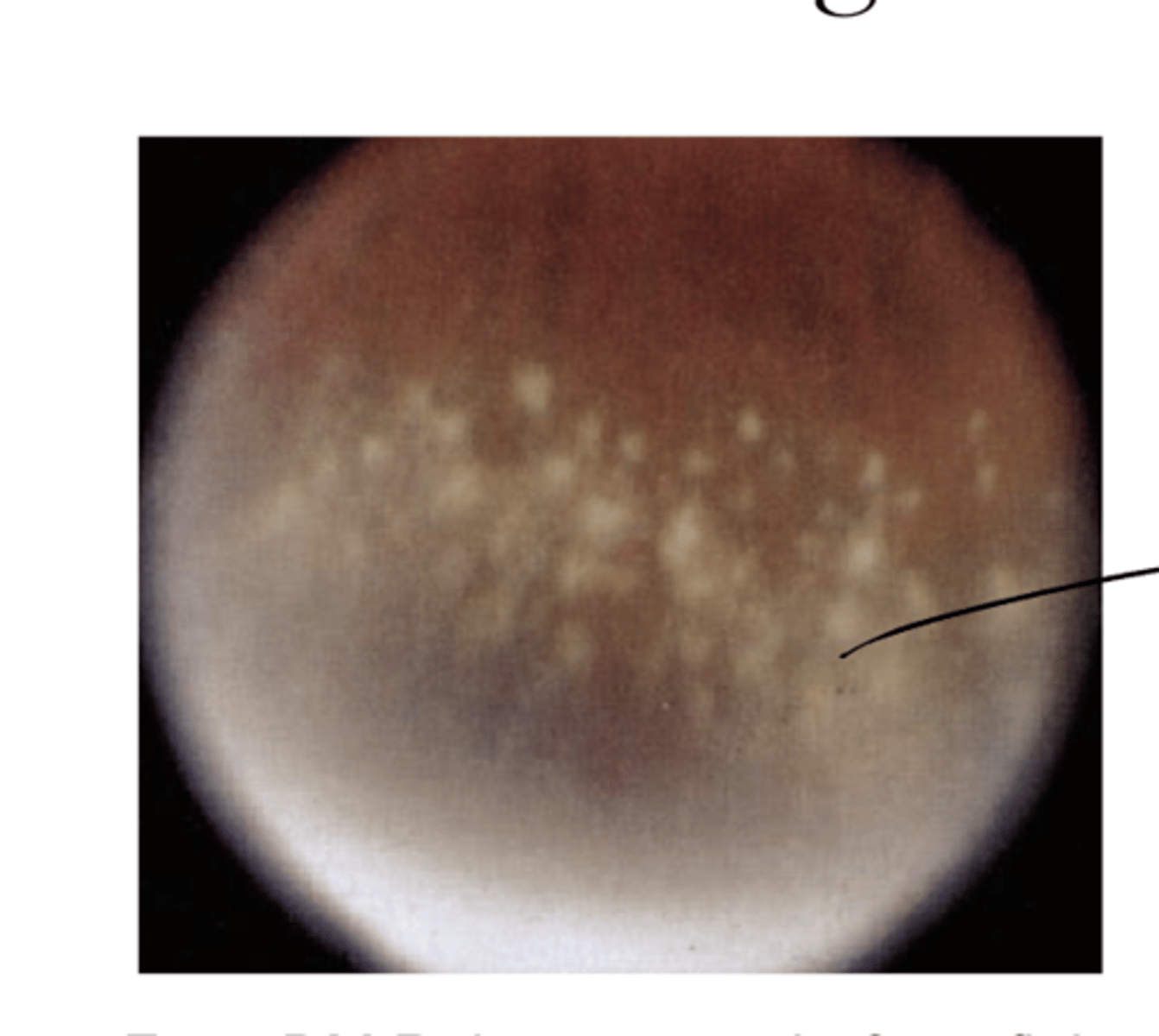 <p>Snowflake Degeneration Pic</p>