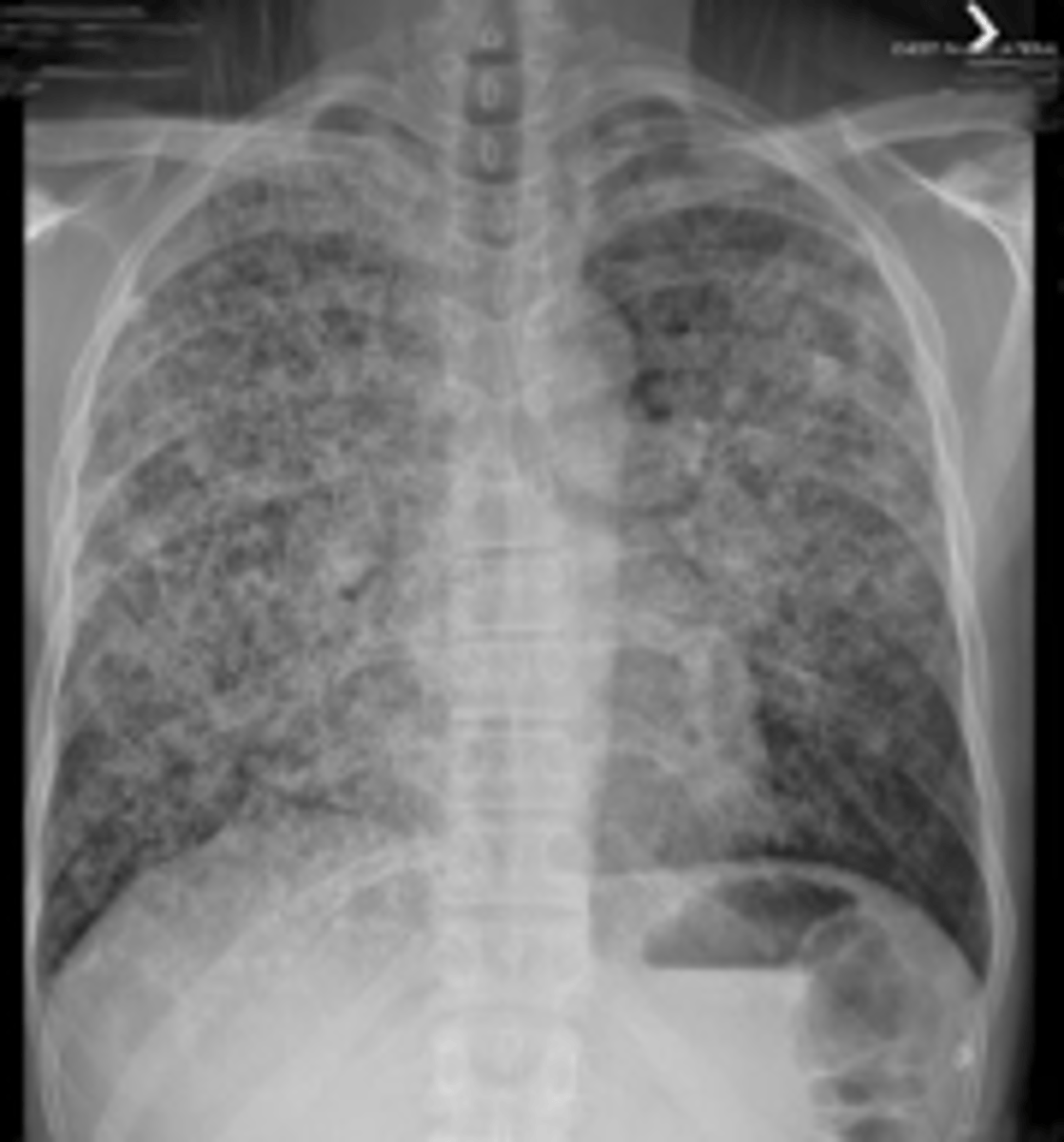 <p>Cystic PJP - PA chest radiograph shows diffuse bilateral reticulonodular interstitial infiltrates</p>
