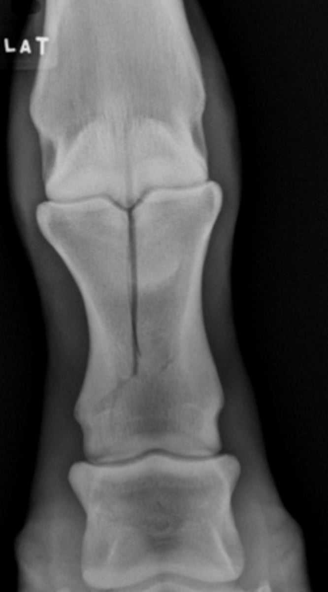 <p>How should this fracture be treated?</p>