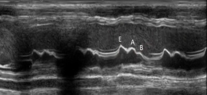 <p>Increased LVEDP seen with DCM will demonstrate? </p>