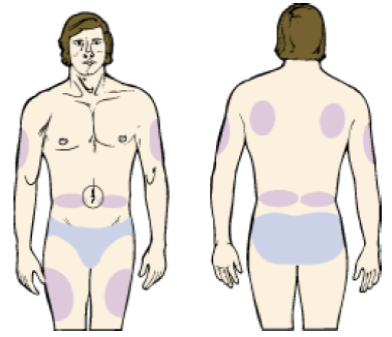 <ul><li><p>Injection area: Subcutaneous fat tissue located beneath the skin between the dermis and muscle. When administering a drug subcutaneously, the skin may be pinched up to avoid giving the drug into the muscle. This route is used for insulin, injectable pain medication, and others where specified.&nbsp;</p></li><li><p>Rotation of injection sites to avoid lipodystrophy.</p></li><li><p>Volumes: Limited to approximately 1 mL</p></li><li><p>Syringes sizes: 1 or 3 mL</p></li><li><p>Needle sizes:&nbsp;</p><ul><li><p>This depends on use. Insulin syringes have ultrafine needles of 30 gauge (a 32 gauge needle is planned), ½ inch, "hypos" are often 25 gauge, ½ to 5/8 inch length.&nbsp;</p></li><li><p>Insulin syringes come with the needle attached. It is left in place for administering the dose after withdrawing the drug from the product vial.&nbsp;</p></li><li><p>For other drugs, the needle used for withdrawing the dose is usually removed; a Luer tip cap is applied; and the nurse or caregiver selects and attaches an appropriate needle at the time of injection.&nbsp;</p></li><li><p>In this case, excess for priming the new needle should be included in the syringe and the syringe labeled to this effect.</p><p></p></li></ul></li></ul><p></p>