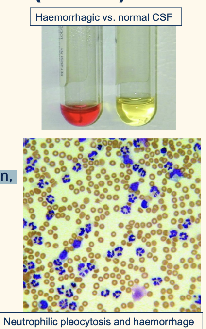 <p><strong><em>Immune-mediated inflammation of the meninges and associated blood vessels</em></strong></p><p></p><ol><li><p><strong>Cerebrospinal fluid (CSF) analysis: </strong></p><ul><li><p>neutrophilic pleocytosis (non-degenerate) +/- haemorrhage </p></li><li><p>can be normal if on/recently had anti-inflammatories </p></li></ul></li><li><p>Elevated serum C-reactive protein (crp) supports clinical suspicion, but not diagnostic </p></li><li><p><u>Rule out infectious causes</u>: </p><ul><li><p>Imaging (radiographs, CT or MRI) </p></li><li><p>CSF bacterial culture </p></li><li><p>PCR/serology for protozoal and tick-borne diseases</p></li></ul></li></ol><p></p><p>red erythrocyte; neutrophil even if lack of bacteria</p>