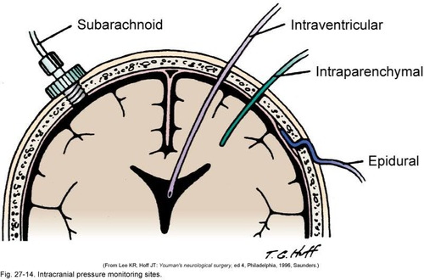 <p>Procedure to control intracranial pressure (ICP).</p>