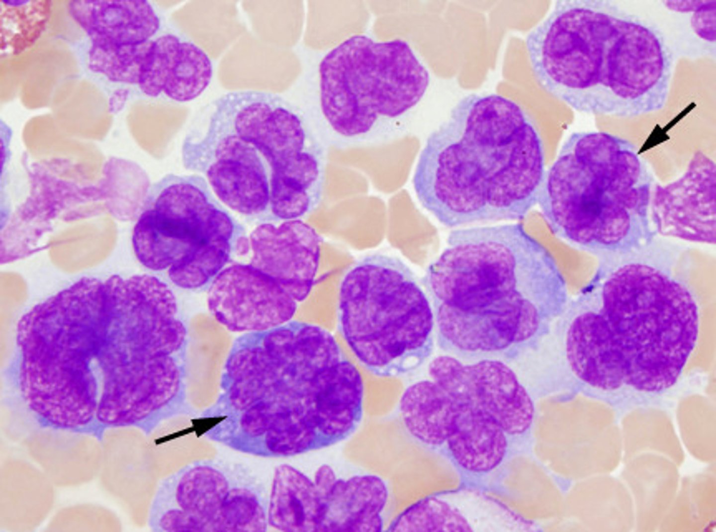 <p>associated with flower cellss in peripheral blood</p>