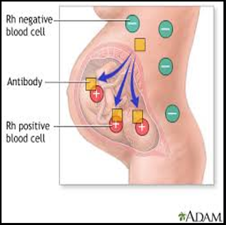 <ul><li><p>Hemolysis</p></li><li><p>Generalized Edema</p></li><li><p>CHF</p></li><li><p>Jaundice</p></li></ul><p></p>