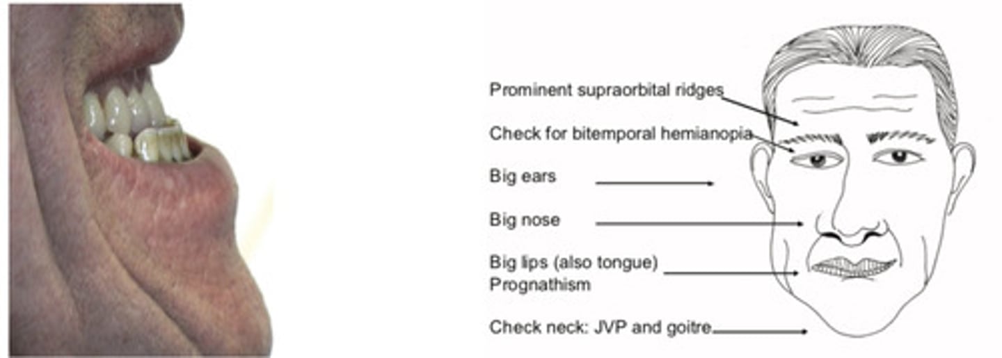 <p>Prominent supraorbital ridges,</p><p>Big ears, nose and lips</p><p>Macroglossia</p><p>Prognathism (from the size) (pro- gnathism= translates as "forward gnashers" ie protrusion of jaw due to overgrowth of the mandible; also leads to wide separation of the teeth)</p><p>Ask patient "Show me your gums" to demonstrate wide separation of teeth and that lower jaw teeth are in front of upper teeth (reversal of normal)</p>