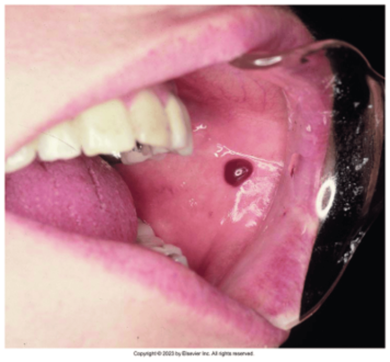 <p>Accumulation of blood within tissues as a result of trauma; Appears as a red to purple to bluish-gray mass; Frequently seen on labial or buccal mucosa</p>
