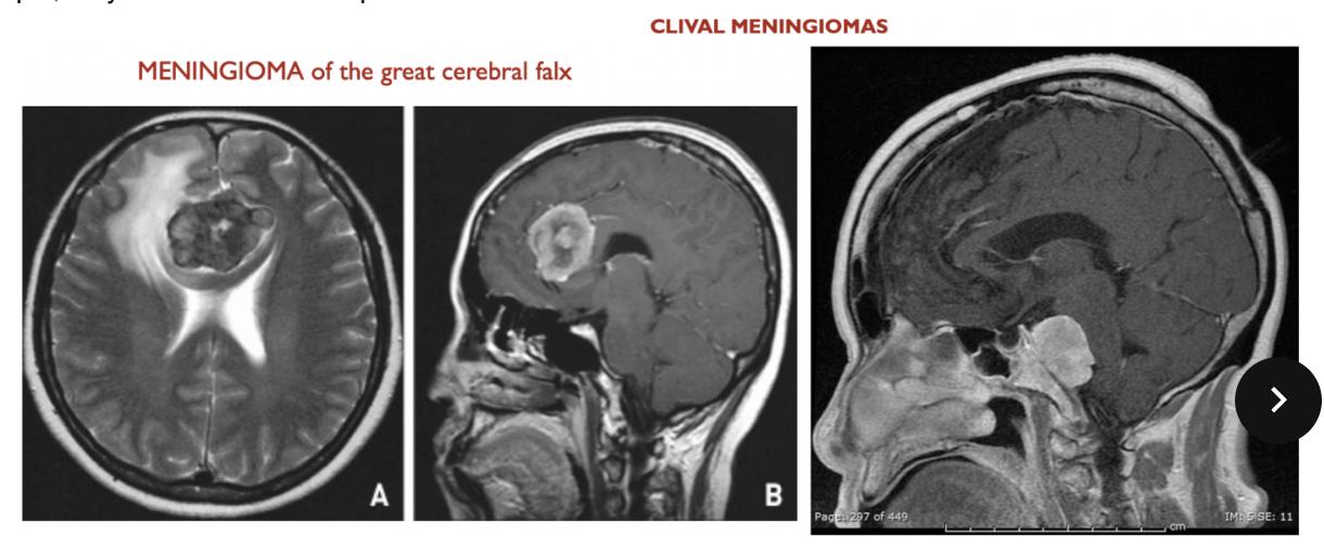 <ul><li><p>In the Us comprise about 32% of all primary intracranial tumours, with an annual incidence of 5.2 per 100000 population</p></li><li><p>Twice as common i women, with regional variation </p></li><li><p>Patients with multiple meningiomeas generally comprise less than 10% of cases</p></li><li><p>Most are beneign</p><ul><li><p>However, while they grow, can compress nervous tissue</p></li></ul></li><li><p>In generall, atypical &amp; anaplastic meningiomas comprimse less than 10% </p></li><li><p>Can be meningiomas of the great cerebrl falx, clival meningiomas, etc. </p><ul><li><p>Clival meningiomas are at the level of the clivus of the occipital bone, which can cause problems for the brainstem</p></li></ul></li><li><p>Meningiomas are often benign growths, but depending on their position can cause damage (ex. compressing brain structures) </p></li></ul>