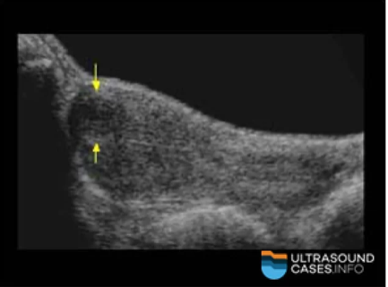 <p>Where is the mass located in the image below?</p><p>a. intramural <br>b. subserosal<br>c. submucosal <br>d. pedunculated  </p>