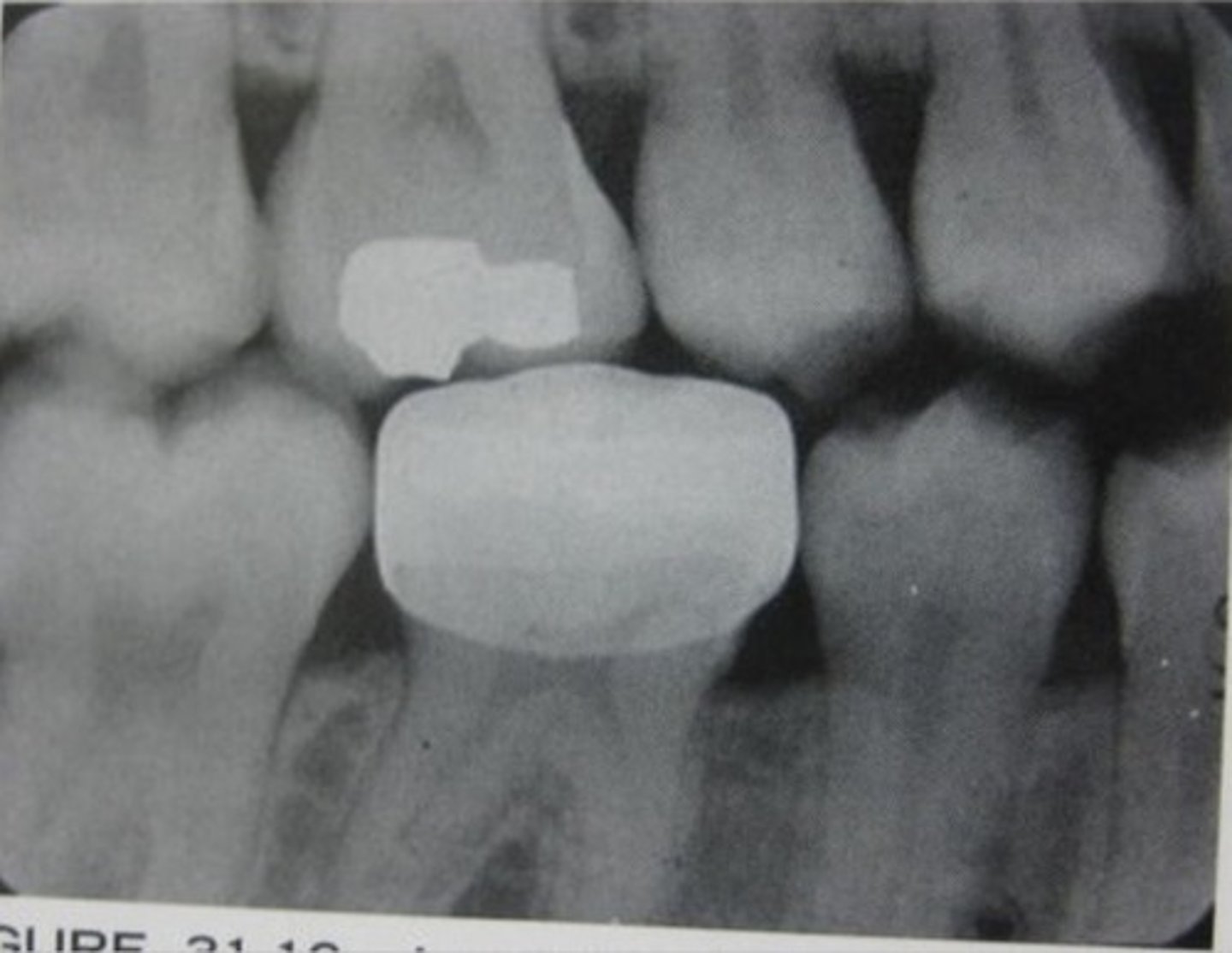 <p>Identify restoration type</p>