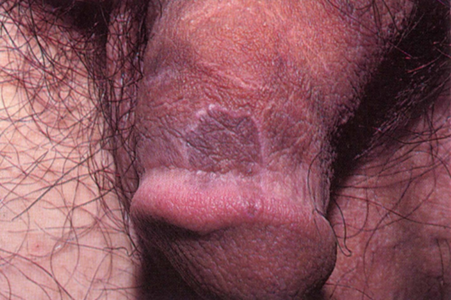 <p>Annular lichen planus</p>