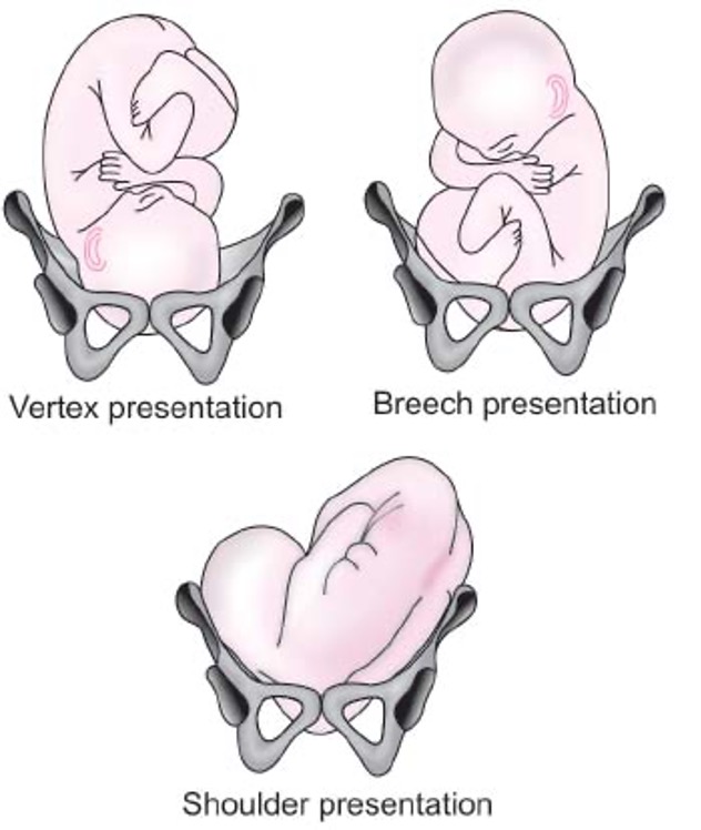 <p>What is the normal presentation?</p>