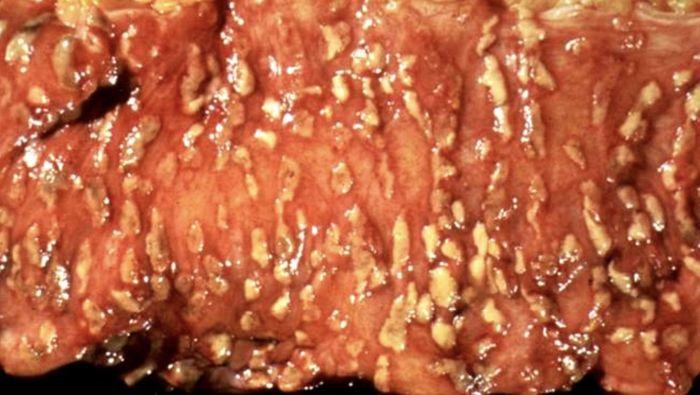 <p>Inflammation with pseudomembrane formation, often due to fibrinopurulent exudate (e.g., C. difficile colitis). AKA antibiotic associated colitis</p>
