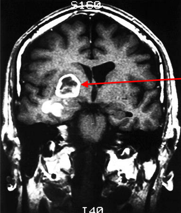 <p>Grade IV astrocytoma </p><p><u>Signs of brain tumours</u></p><ul><li><p>Seizures</p></li><li><p>Worsening vision</p></li><li><p>Sensory and motor abnormality</p></li><li><p>Headache</p></li><li><p>Stroke-like symptoms</p><p></p></li></ul><p><u>Diagnosis</u></p><ul><li><p>CT shows ring-like contrast enhancement aginst central necrosis</p></li><li><p>Biopsy shows pleomorphism, high cellularity and infiltration of tumour cells, palisaded necrosis and microvascular proliferation</p></li></ul><p></p>