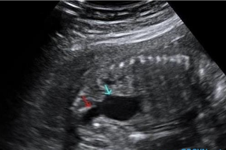 <p>what congenital anomaly is shown</p><p>a) renal agenesis</p><p>b) duodenal atresia</p><p>c) anal atresia</p><p>d) posterior urethral valves</p>