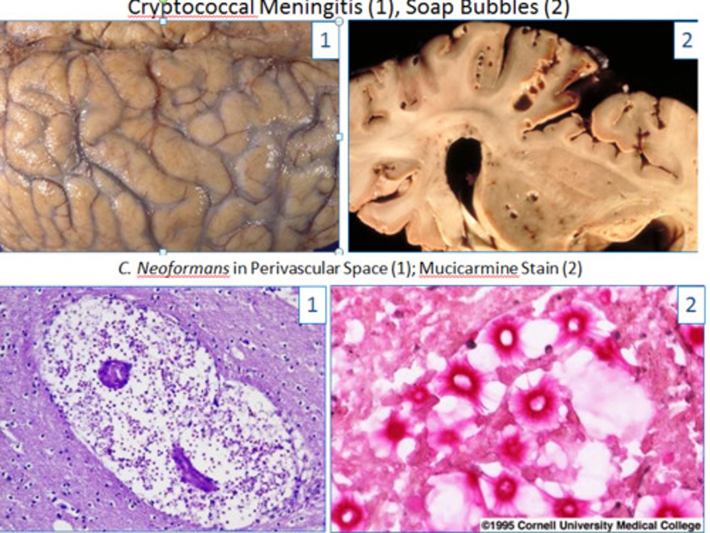 <p>Cryptococcal meningoencephalitis</p><p>- Cryptococcus neoformans</p><p>- CSF: high opening pressure, low glucose, high protein, WBC < 50, transparent capsule seen with india ink stain, cryptococcal antigen +, culture on Sabouraud agar</p><p>Tx: Initial amphotericin B with flucytosine</p><p>Maintenance: fluconazole</p>
