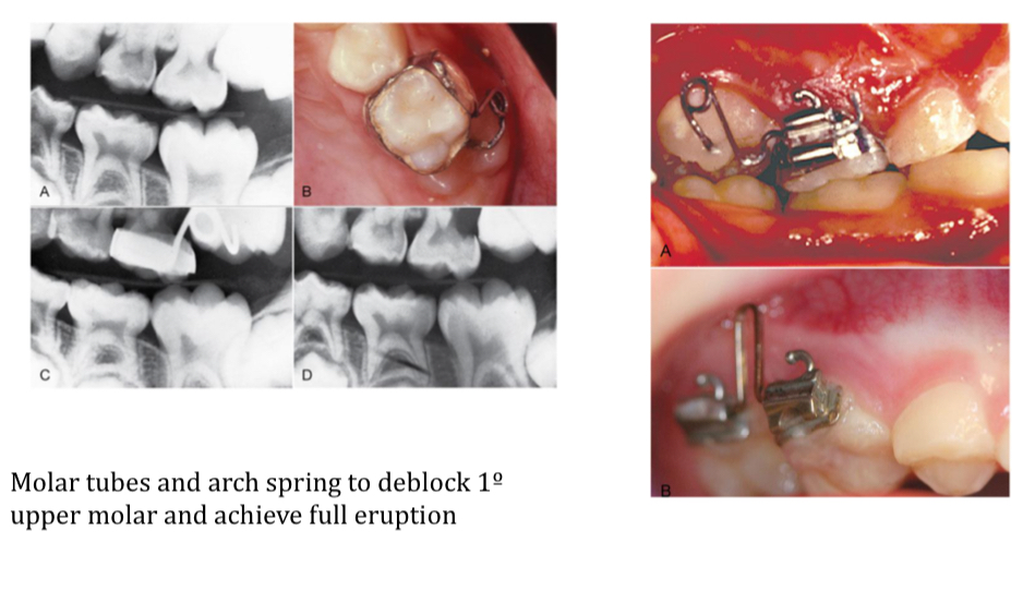<p>When erupting mesially, reabsorbs 2nd temp molars prematurely</p><p>Negative discrepancy</p><p>If root resorption limited to 1-1.5mm- no treatment</p><p>Treat if blocks for over 6 months or root resorption continues</p>