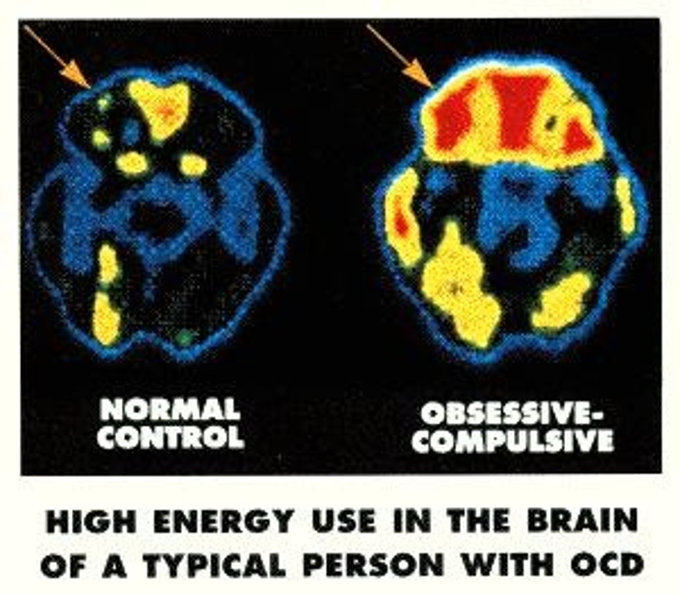 <p>Characterized by intrusive thoughts followed by compulsive behaviors to relieve the intrusive thoughts.</p>