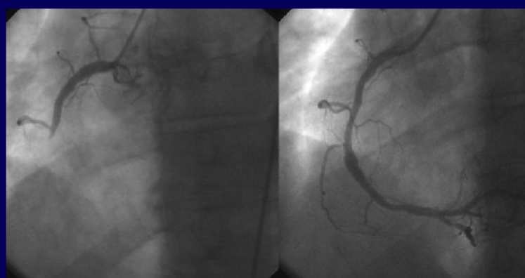 <ul><li><p>cardiac catheterization (left image shows blockage, right is after being fixed there is blood downstream)</p></li><li><p>stenting</p></li></ul><p></p>