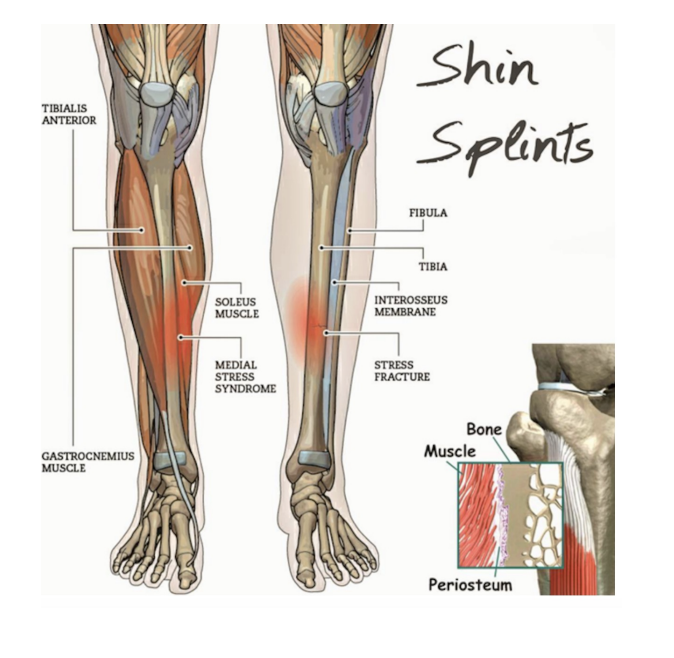 <p>Medial Tibial Stress Syndrome</p>