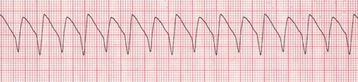 <p>BAD, ventricles are pumping too fast</p>