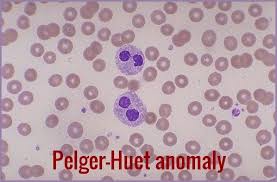 <ul><li><p>hyposegmentation of neutrophils</p></li><li><p>in heterozygotes, the nucleus is dumbbell shaped, in homozygotes, the nucleus is spherical and has no lobes</p></li><li><p>pseudo-pelger huet seen in myeloproliferative disorders</p></li><li><p>can be misidentified as bands or metas</p></li></ul><p></p>
