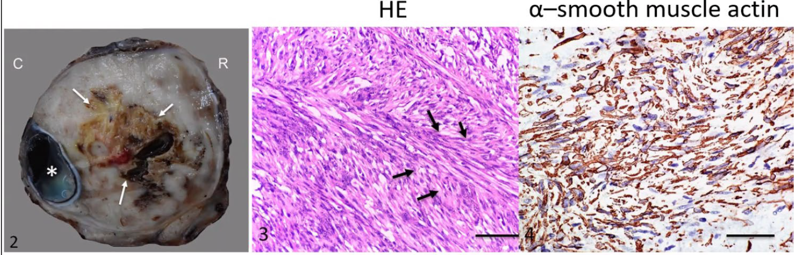 <p>Neonatal calf; what is the diagnosis?</p><p>A-Schwannoma</p><p>B-Leiomyosarcoma</p><p>C-Hemangiosarcoma</p><p>D-Fibrosarcoma</p>