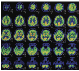 uses a scanning device to take coloured images of the brain, showing its functional activity by tracing the levels of a radioactive substance in the brain.