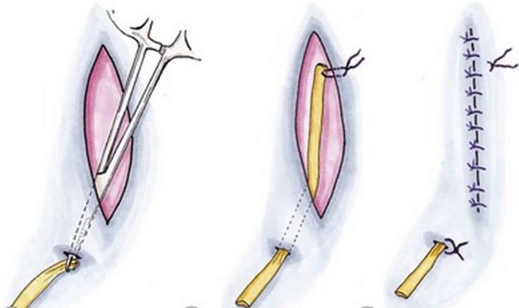 <p>Gravity drain placed in the wound; passive drain; also used to retract spermatic cord during inguinal hernia surgery.</p>