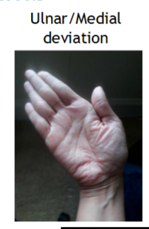 <p>Moving wrist towards the medial side</p>